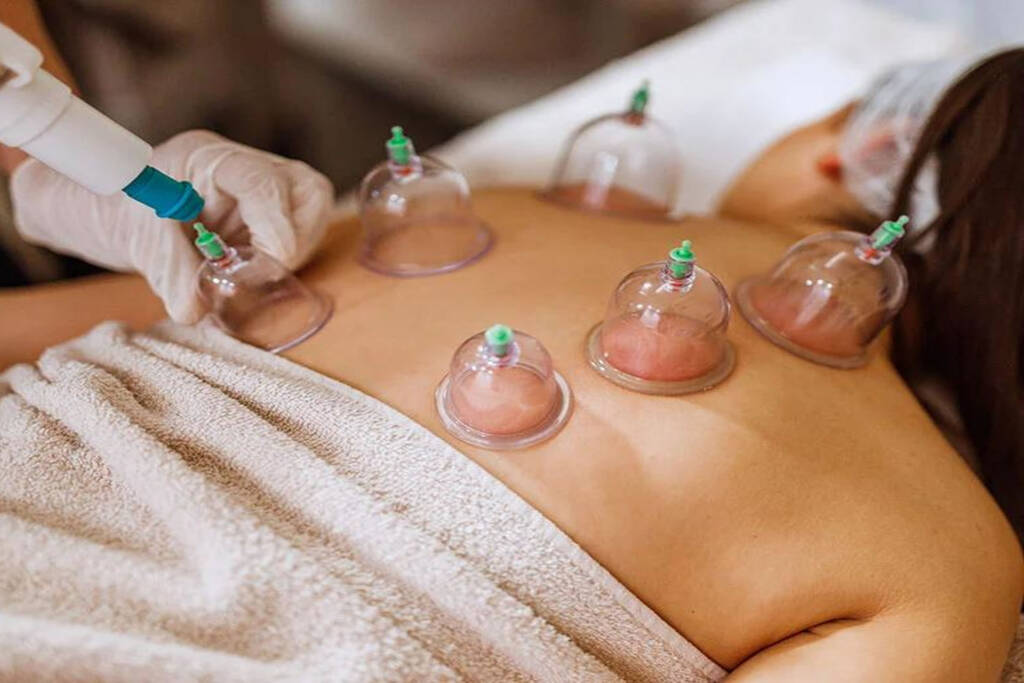 This image has an empty alt attribute; its file name is cupping-treatment-singapore-1024x683.jpg